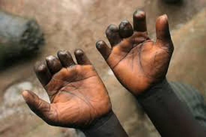 Nord-Kivu : Butembo a enregistré 13 cas de lèpre entre 2019 et 2023