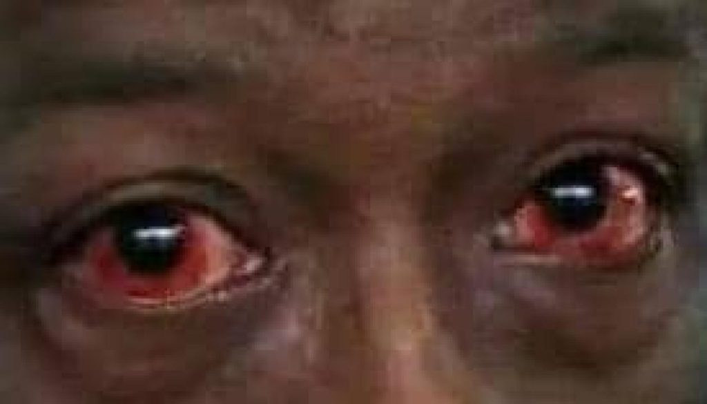 Nord-Kivu : « APOLLO », une nouvelle épidémie expliquée par un ophtalmologue